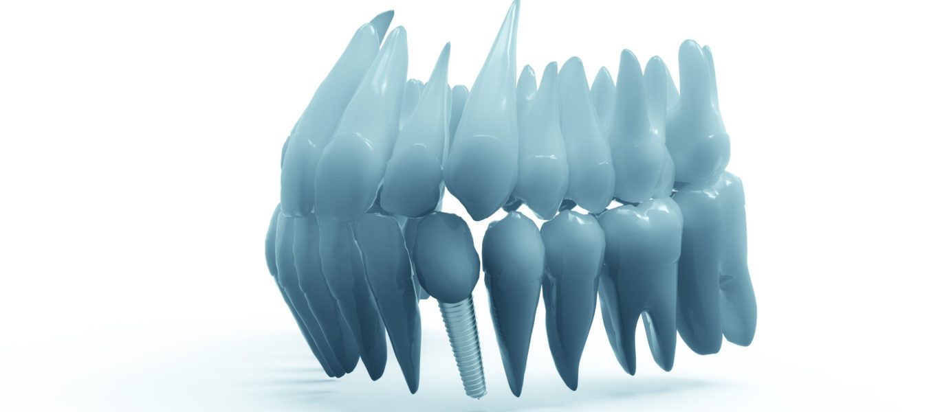 transducteur ultrasonore WaveImplant