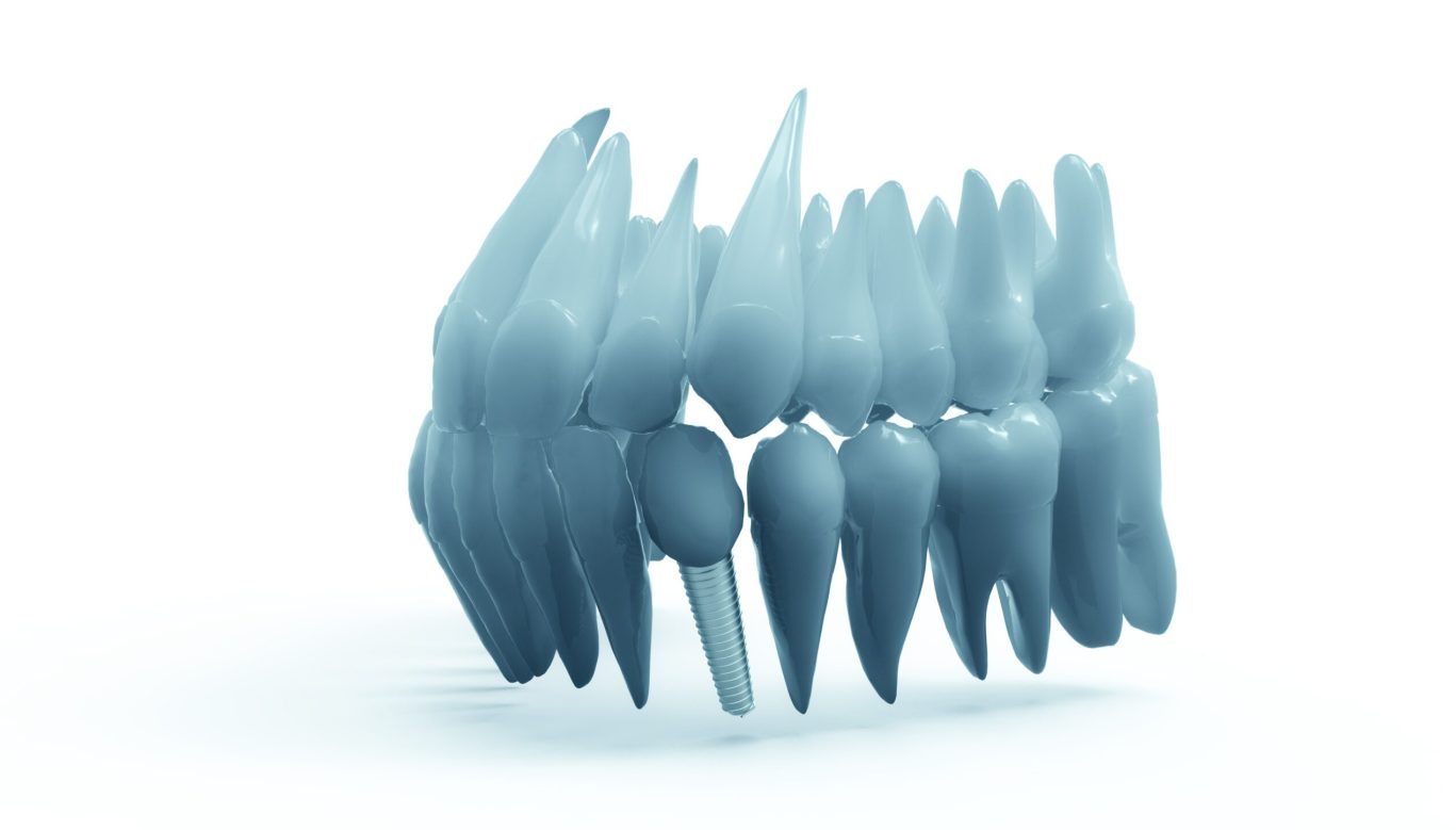 transducteur ultrasonore WaveImplant